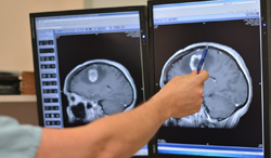 tumori cerebrale3