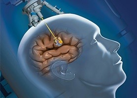 tumori cerebrale4