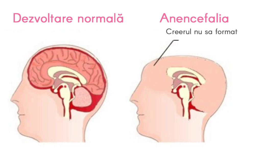 anencefalia