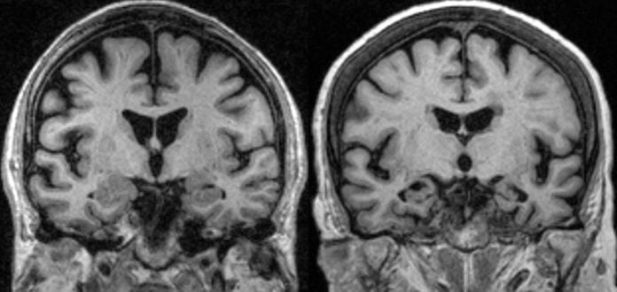 corticobasal degeneration